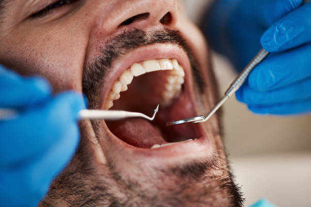 Best Root Canal Emergency Dentist  in Bee Ridge, FL